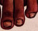 Illustration of a tropical ulcer kept as reference by Major Arthur Moon at Changi. Illustration of a tropical ulcer kept as reference by Major Arthur Moon at Changi.